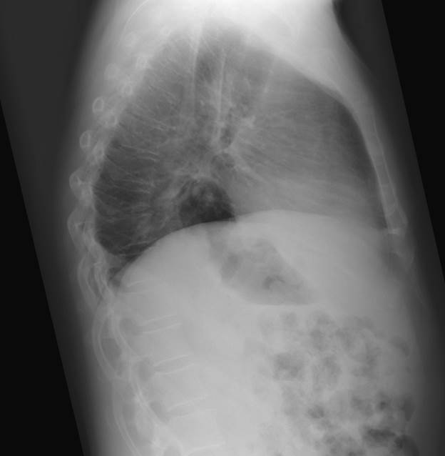 A shadow of air within the heart