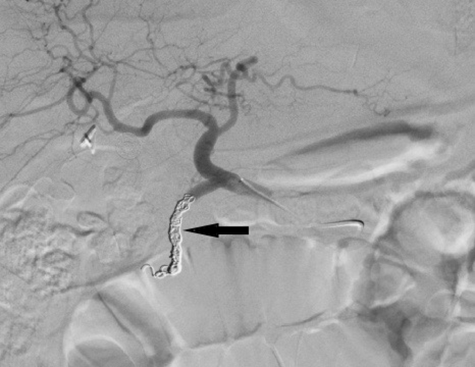 Obscure gastrointestinal bleeding secondary to gastroduodenal