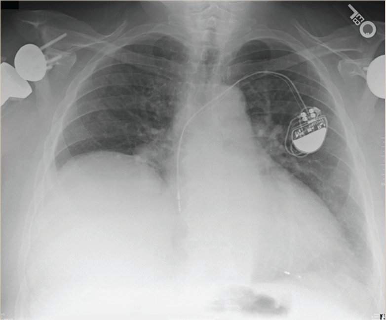 View of Diaphragmatic Paralysis The Southwest Respiratory and Critical Care Chronicles