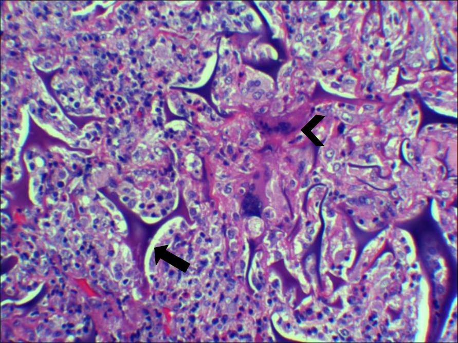 Foreign body granulomas after a craniotomy for meningioma Panichpisal The Southwest