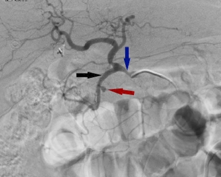 Obscure gastrointestinal bleeding secondary to gastroduodenal