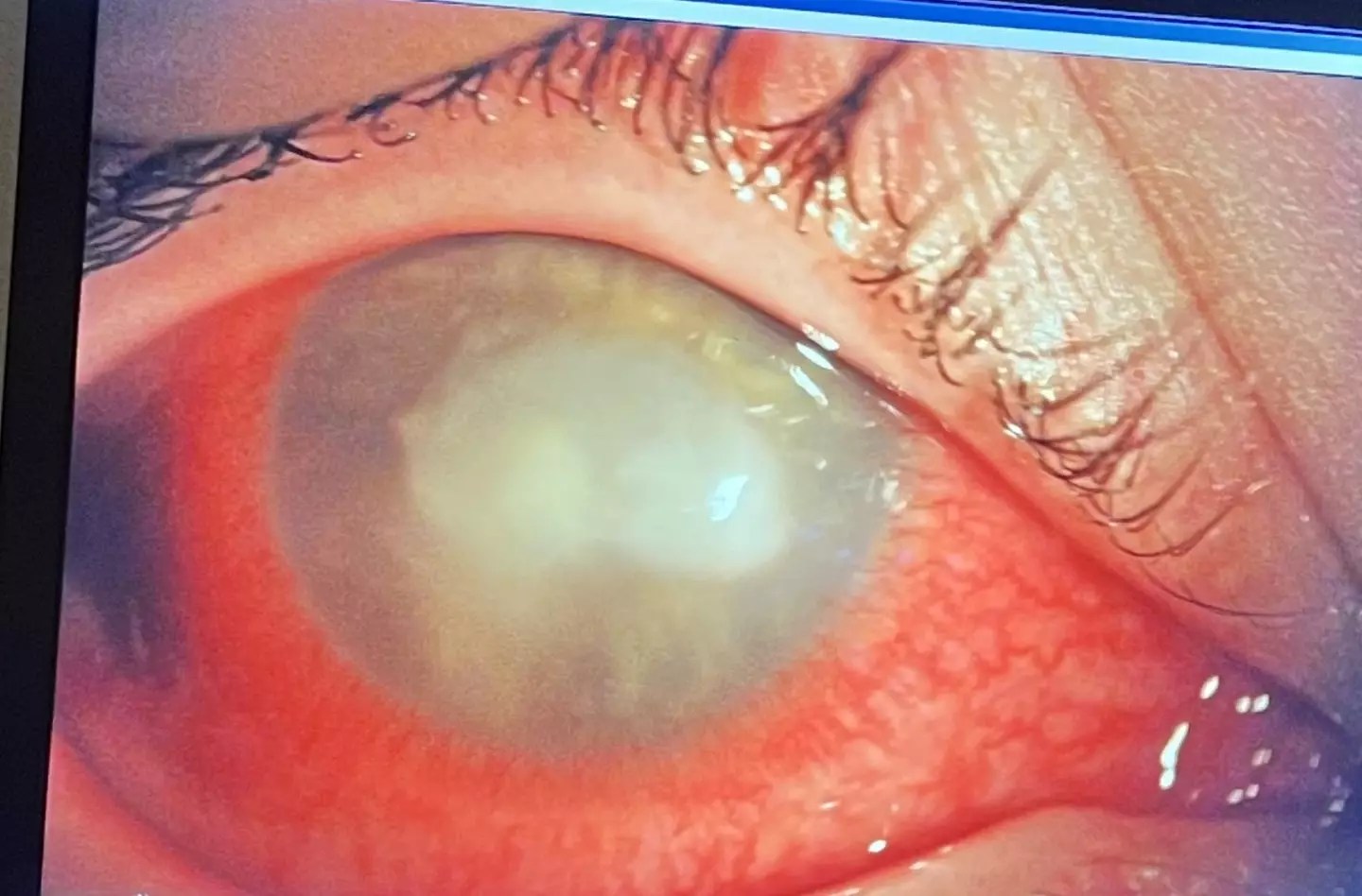 Woman loses sight after ‘grain of sand’ in her eye reveals a more