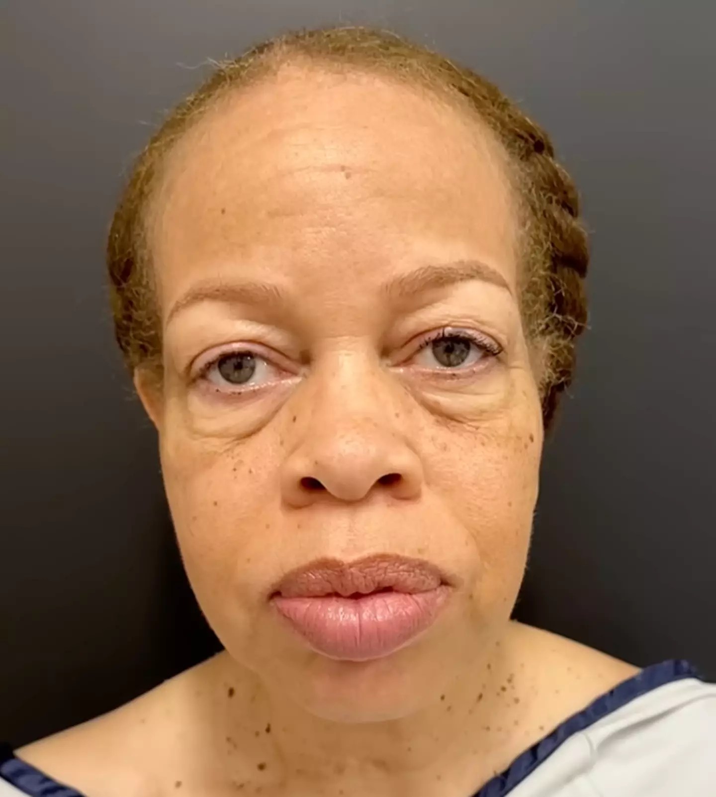 Woman Undergoes Full Face Rejuvenation with Astonishing Before and(07)