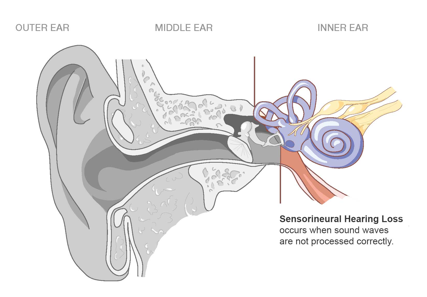 earinner1 Pulsatile Tinnitus