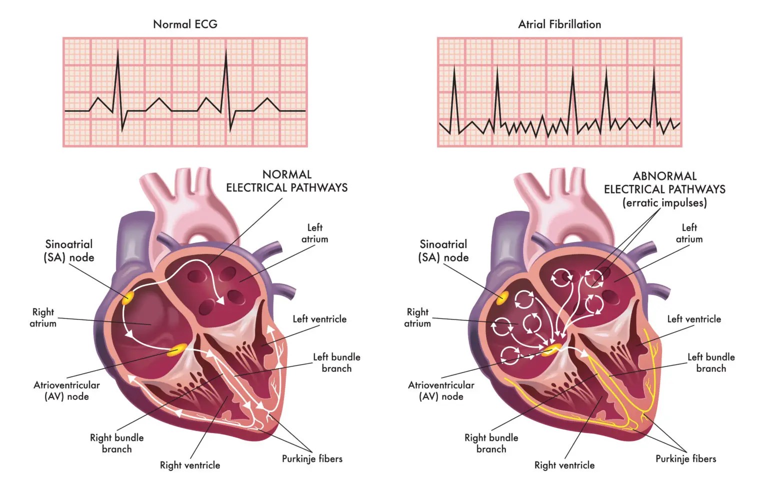 Difference between Atrial Fibrillation and Atrial Flutter Pulse