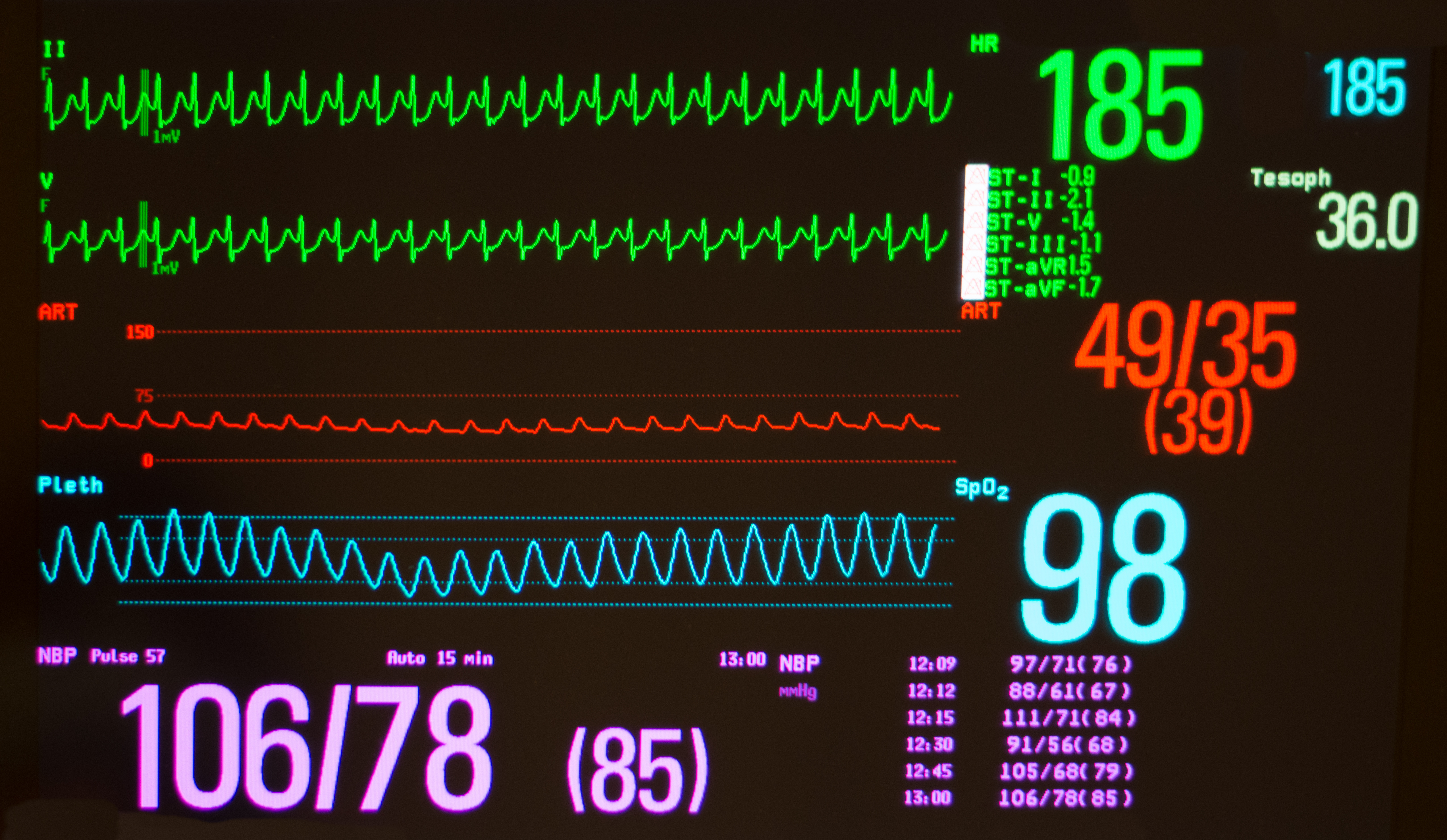 What is Tachycardia, Symptoms, and Treatment Pulse Cardiology
