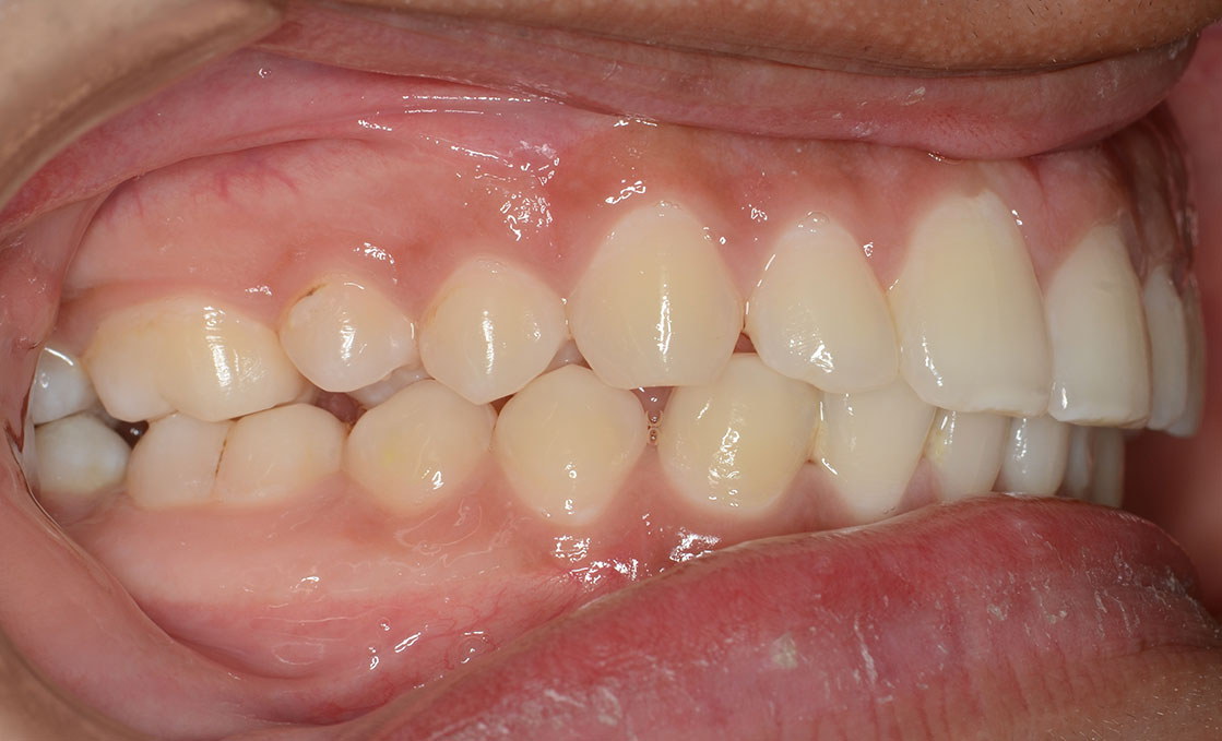 Orthodontics Treatment in Ahmedabad, India at Pulse Orthodontia Pulse