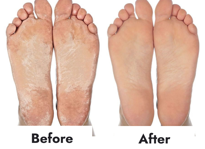 Foot Callus Remover Pumice Stone Co.