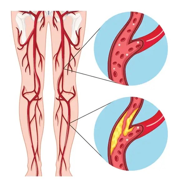 Treatment for Peripheral Artery Disease