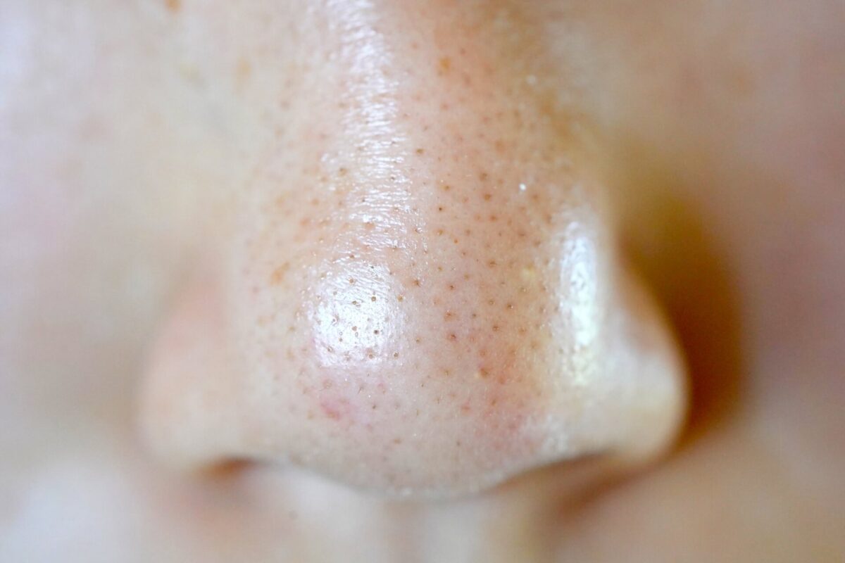経験談】私が鼻の黒ずみ・いちご鼻を解消した方法！治し方！毛穴を小さくする裏技紹介！〜毎日スキンケア〜 - Youtube いちご鼻退治のプロが伝授！】黒ずみ毛穴が治らない原因とタイプ別