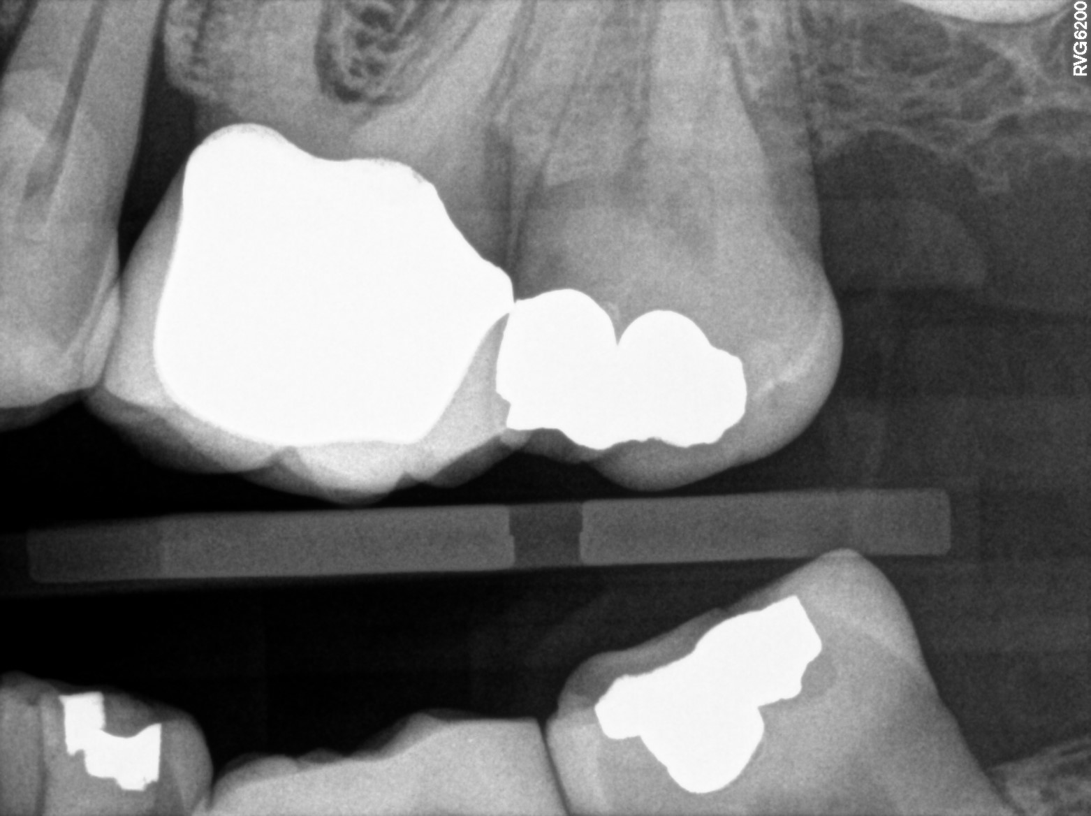 Instruments to unroof disc like pulp chambers to find canals Pure