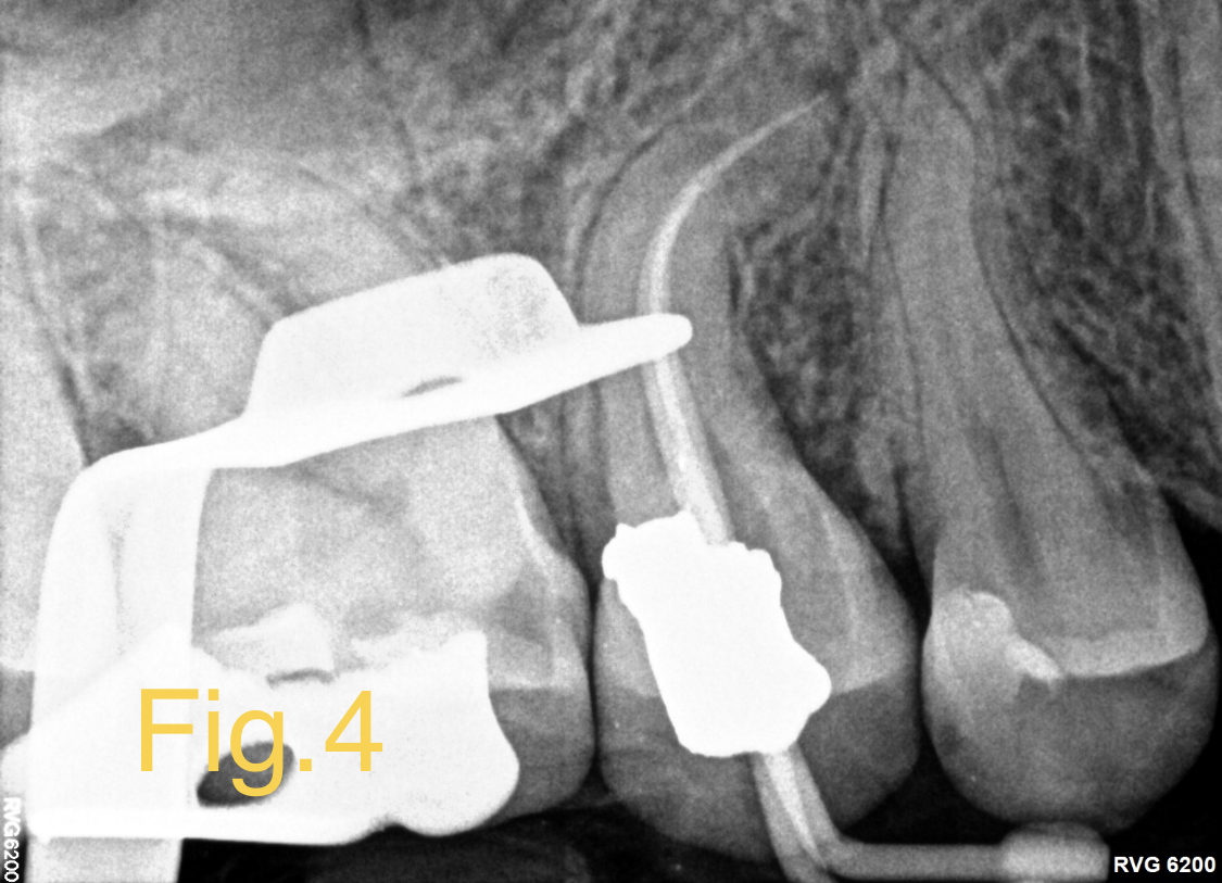 Enjoy Minimally Invasive Endodontics with Laser Activated Irrigation