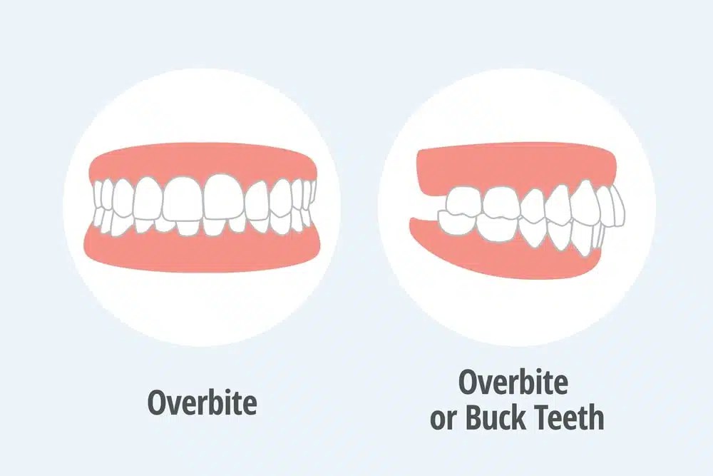 Overbite vs Normal Bite Differences, Causes, and Treatment