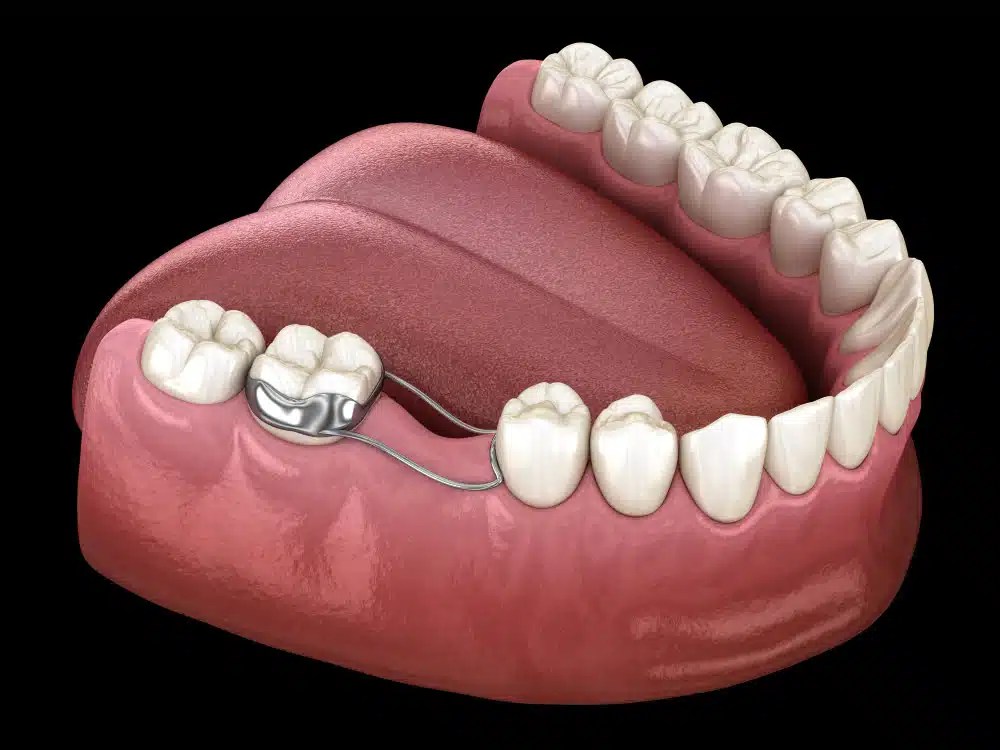 Tooth Space Maintainer Preserving Smiles with Dental Appliances