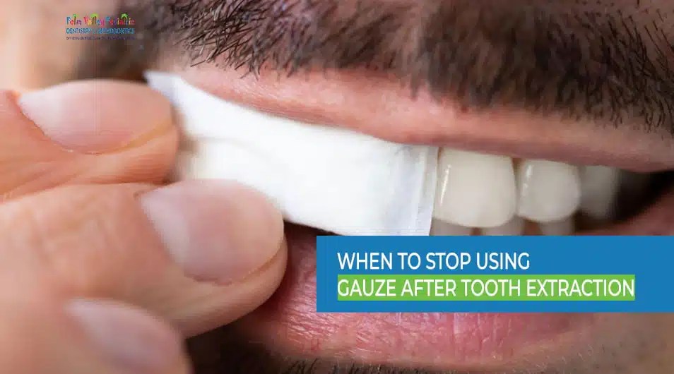 When Do I Remove Gauze After Tooth Extraction at Denise Broussard blog