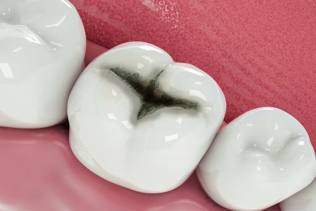 Tooth Colored Fillings Procedure, Safety, Benefits and Drawbacks