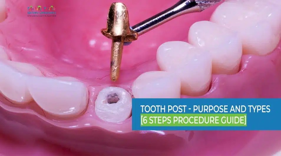 Tooth Post Purpose and Types [6 Steps Procedure Guide]
