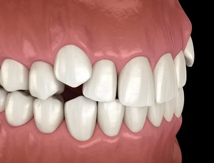 Early Interceptive Orthodontic Treatment Pymble Orthodontist