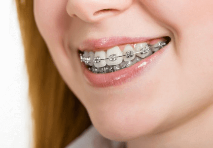 Precio Brackets Madrid Ofertas en ortodoncia P&P Clinic