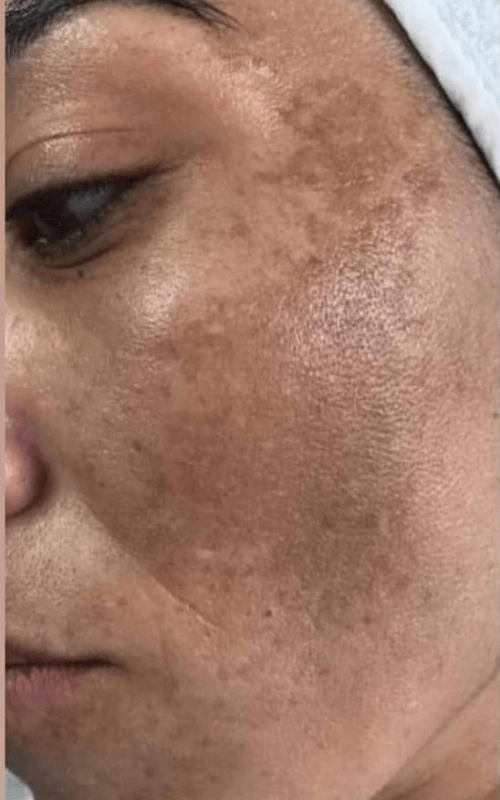 Tratamiento Láser IPL Madrid Precios y opiniones P&P