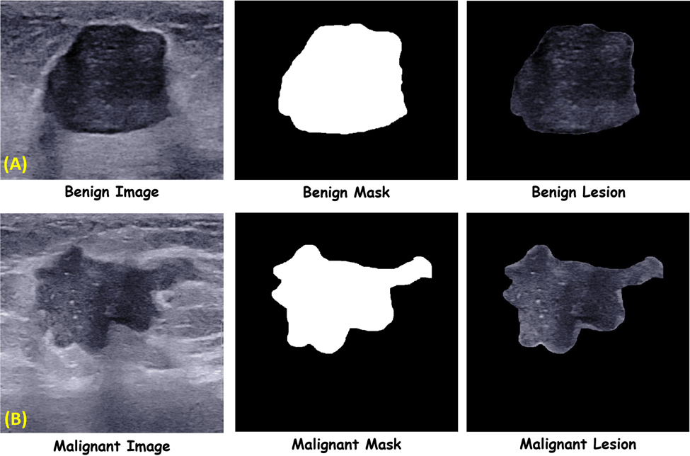 An openaccess breast lesion ultrasound image database‏ Applicable in