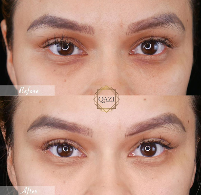 What Are The Benefits of Fillers Under Eyes? Qazi Cosmetic Clinic
