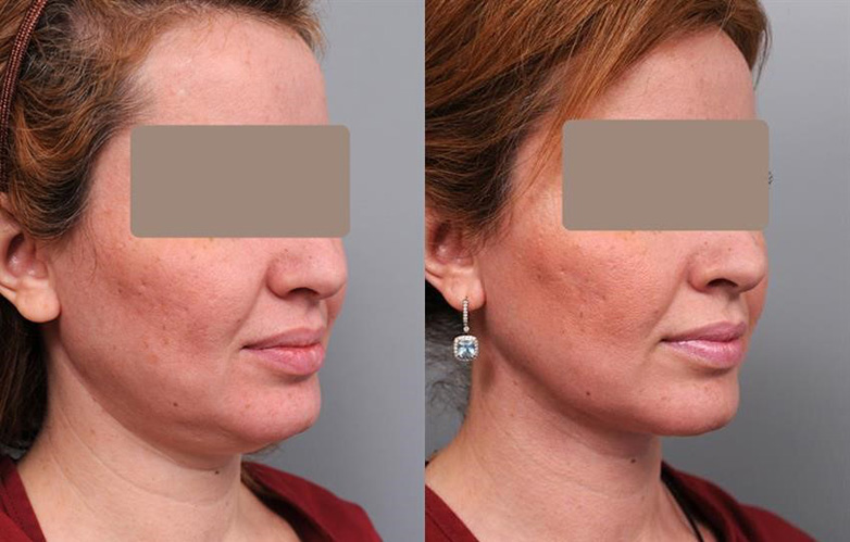 Neck Wrinkles Treatment Lasers Captions Trending Update