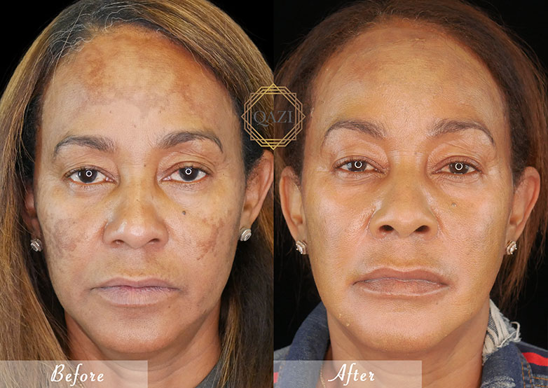 Pico Laser Treatment Say Goodbye to Skin Imperfections