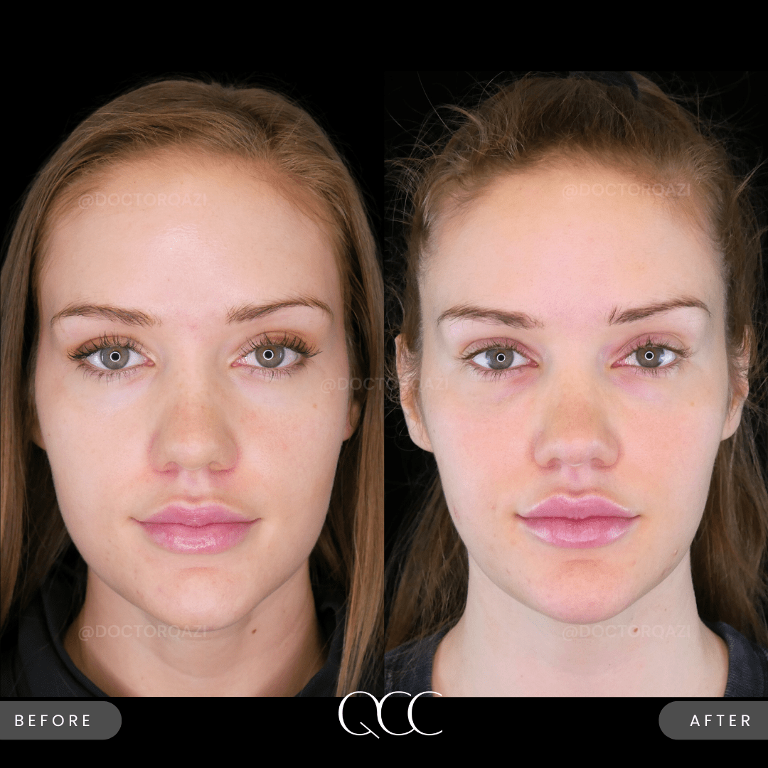 Masseter Botox using Dysport