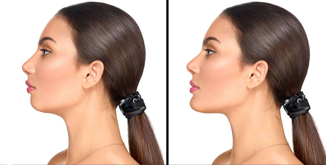 Chin and Neck Contouring Procedures Queen City Plastic Surgery