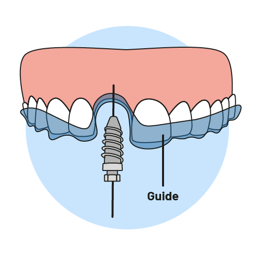Guided Implant Surgery Best Dental Implant Solution In QLD