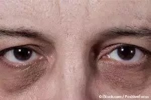 Why Do We Get Black Spots Under Eyes? - Quora