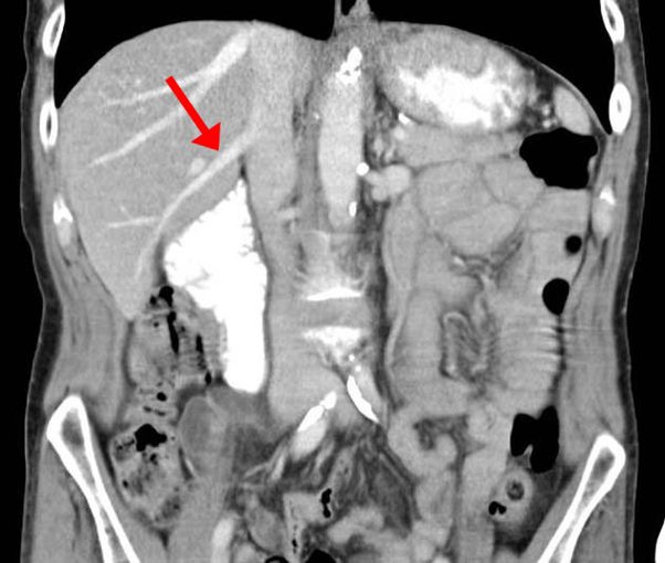 What's the definition of unremarkable when used in CT scan results? Quora