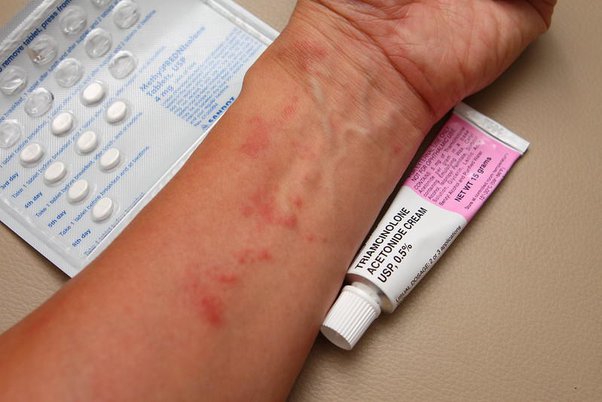 What Is Triamcinolone Acetonide Cream? - Quora