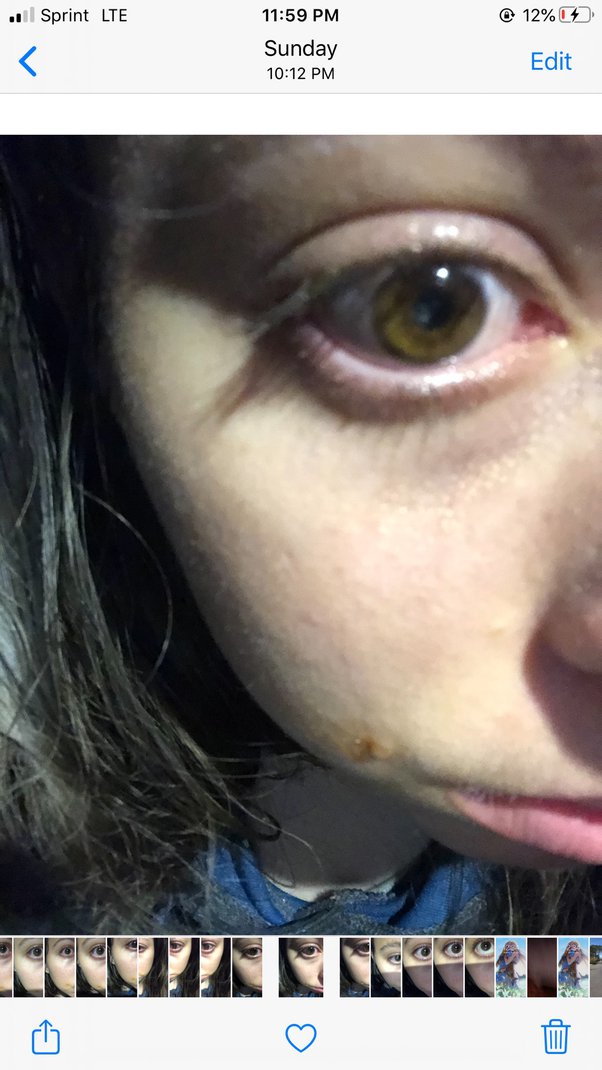 What happens if you push on a black eye? Quora