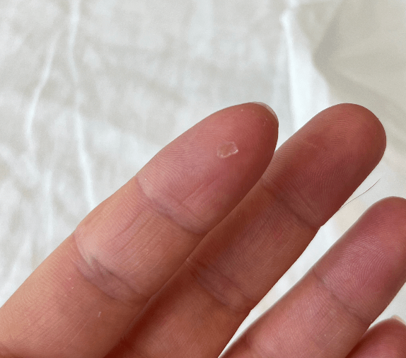 Glass Splinter In Foot Removal