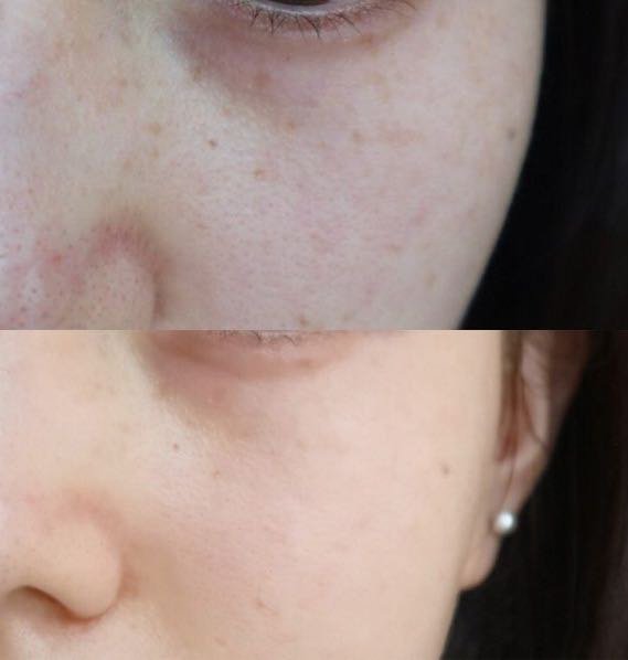 How to remove dark spots fast and permanently Quora