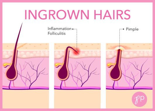 How do l get rid of ingrown hair scars and bumps? - Quora