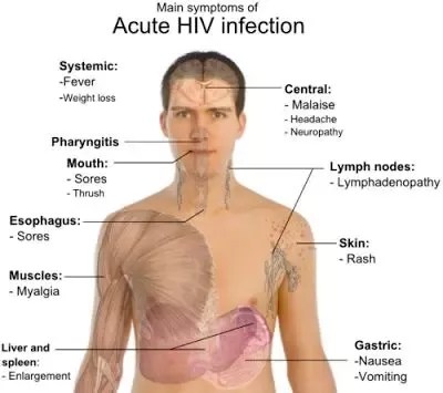 What Are The Symptoms Of Hiv? - Quora