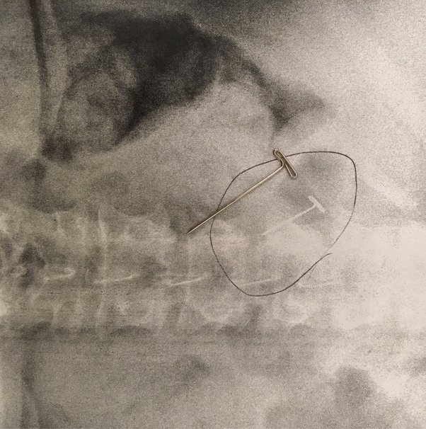 What risk do I have if I swallow a small screw? Quora