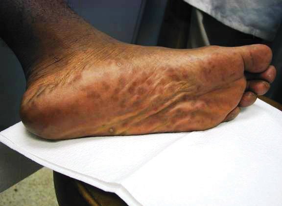 What Might Cause Brown Spots On The Bottom Of Your Feet? - Quora