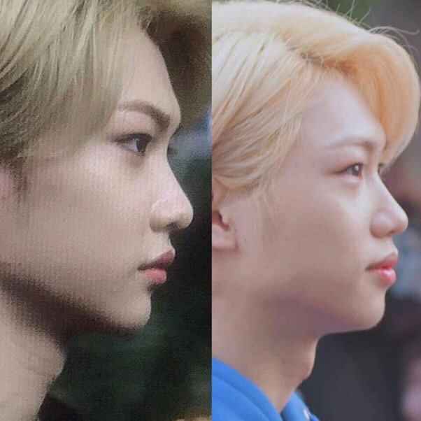 Did Felix from Stray Kids get surgery on his face? - Quora