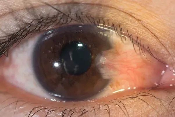 What Causes A Yellow Bump On My Eyeball? - Quora