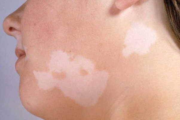 What Are The Best Ways To Cure White Patches? - Quora