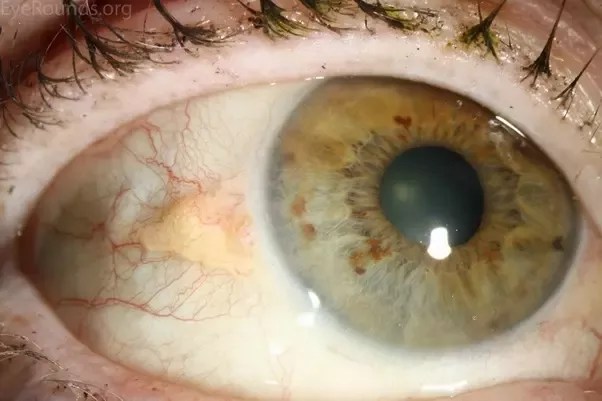 What Causes A Yellow Bump On My Eyeball? - Quora