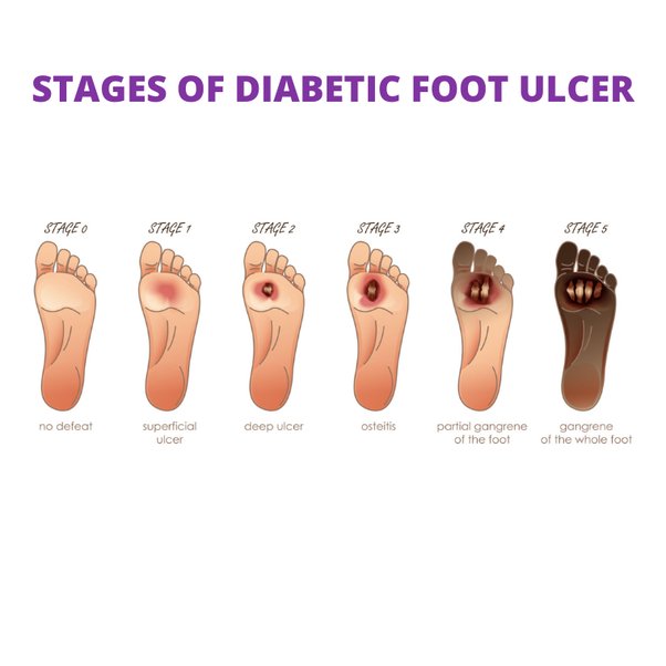 Why does my diabetic foot ulcer smell like ammonia? Quora
