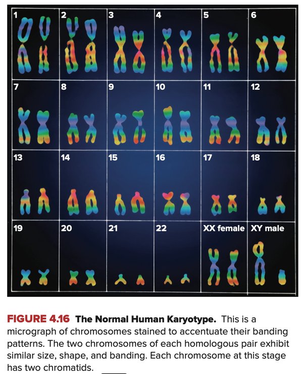 What is the karyotype of albinism? What are its characteristics? Quora