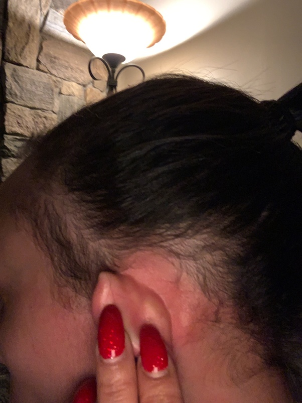 Can hair extensions cause bald patches in the scalp? Quora