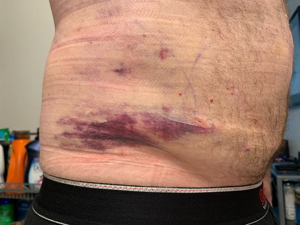 What's it like to get liposuction? Quora