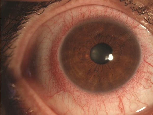 Is it possible for a disposable soft contact lenses to get stuck on